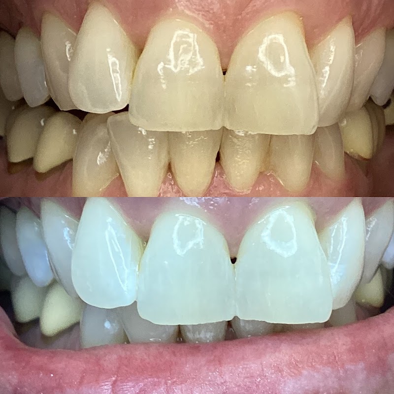 We Whiten Teeth Whitening — photo 5