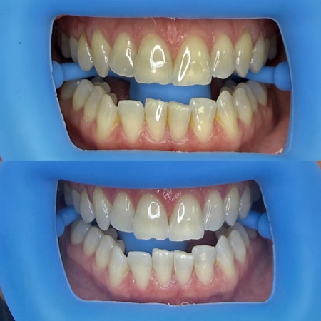 Smilenova Teeth Whitening — photo 5
